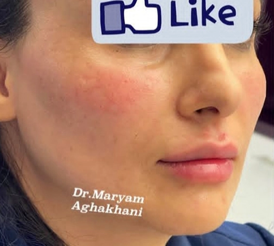 بعد از کانتورینگ صورت در تبریز در کلینیک دکتر آقاخانی تبریز