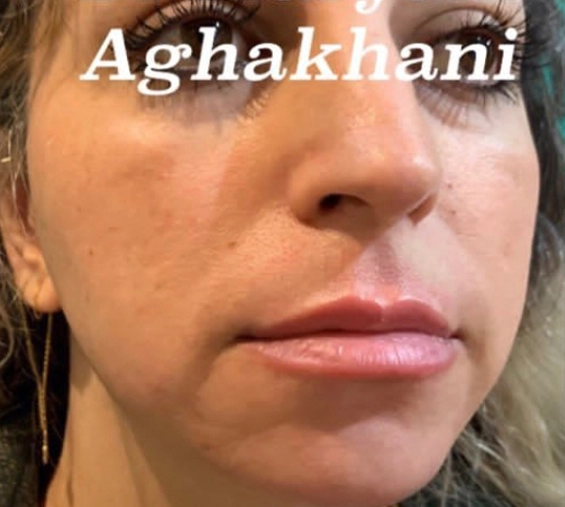 قبل از کانتورینگ صورت در تبریز در کلینیک دکتر آقاخانی تبریز
